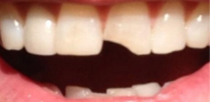 dente-quebrado